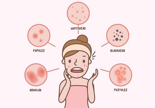 cach-han-che-mun-o-tuoi-day-thi