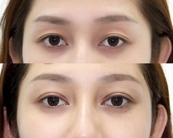 khac-phuc-mi-lot-truoc-sau