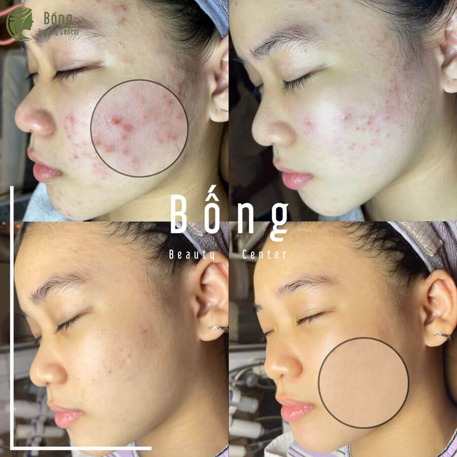 Bongbeauty đơn vị cấy exosome uy tín hcm